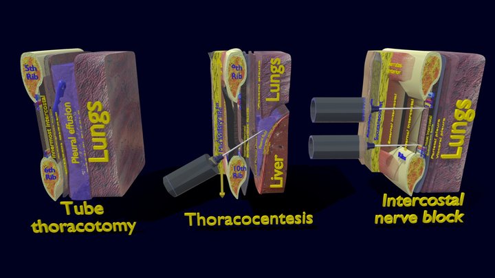 3D thoracic Thorax Procedures Animated 3D Model