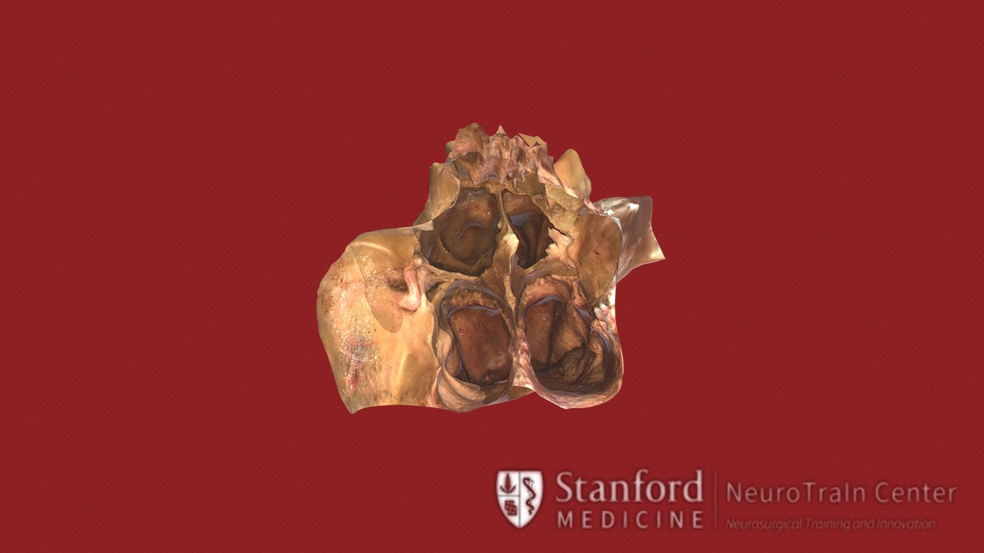 Rostrum and Sphenoid Sinus Exposure - 3D model by vv (@verav) [743fa52 ...
