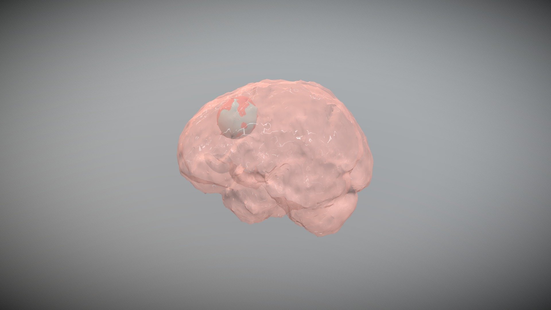 Segmentation of MR Brain Tumors