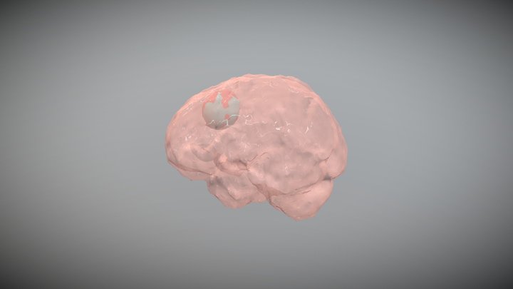 Segmentation of MR Brain Tumors 3D Model