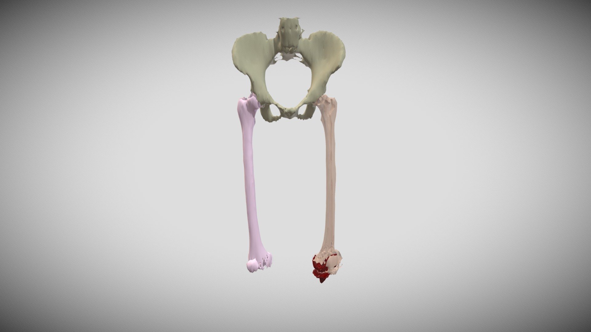 Segmentation of Femurs, Pelvis, and Knee Implant — Sketchfab embed 3D viewer