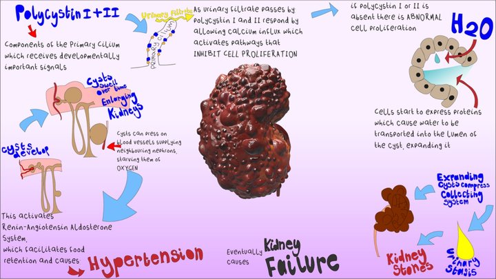 Polycystic Kidney 3D Model