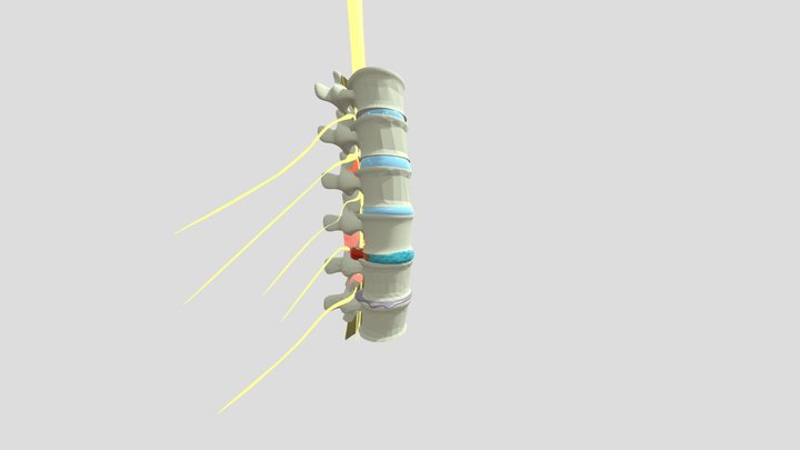 Lumbar Spine with pathology for Medical Teaching 3D Model