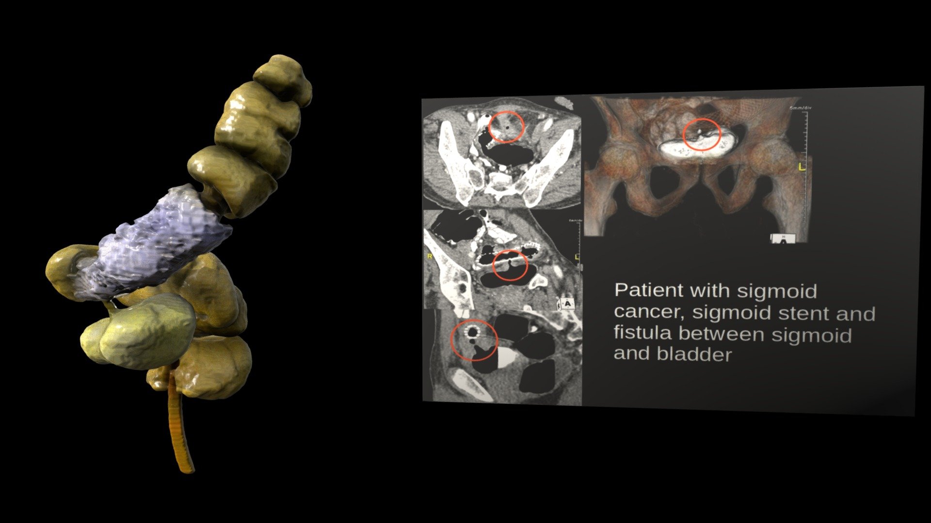 Sigmoid Cancer with Stent and Bladder Fistula