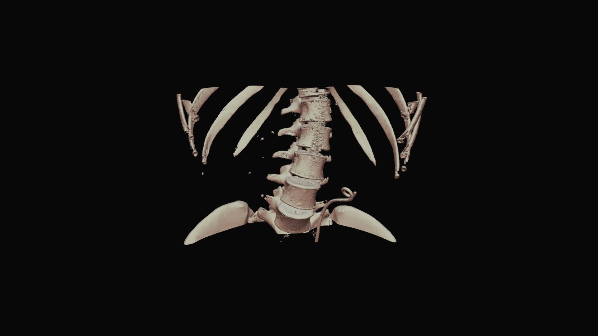 3D dicom model 1