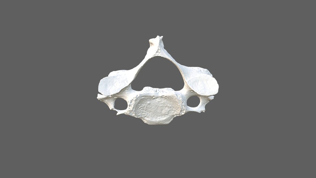 Cervical Vertebra 1