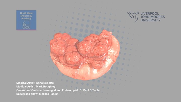 Lateral Spreading Lesion © 3D Model