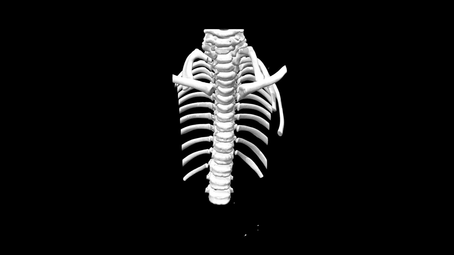 Klippel Feil Syndrome, riba and spine anomalies