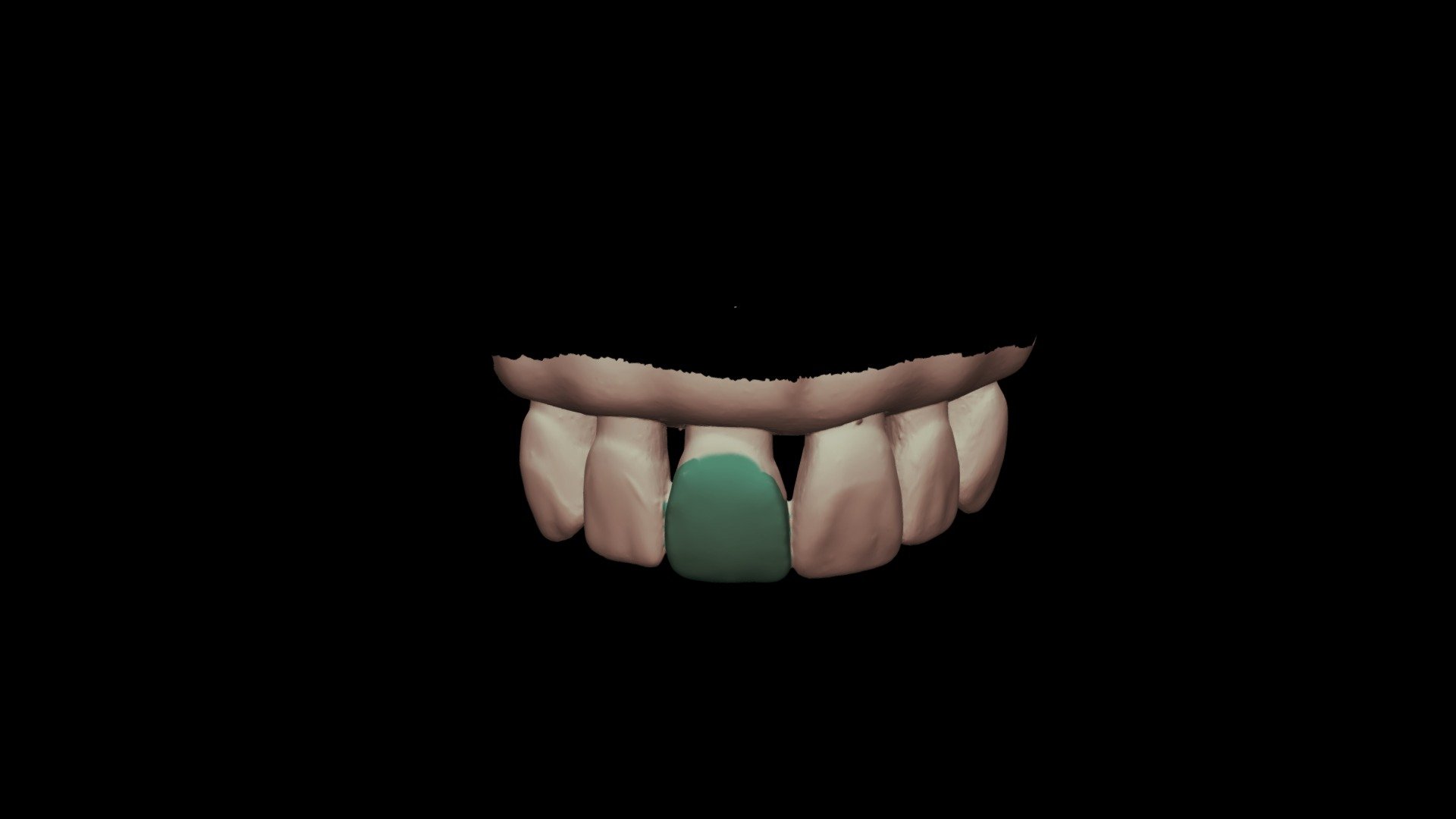 Step 7: Final Waxup on Dentoform