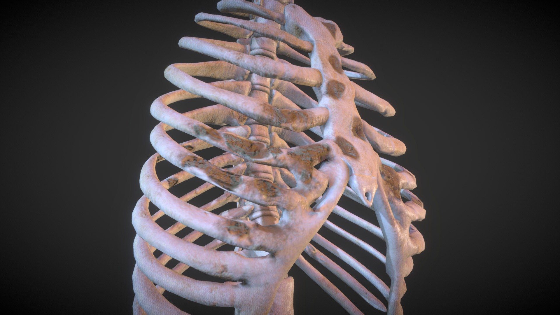 Lytic lesions of rib - Buy Royalty Free 3D model by Ebers [787246b ...