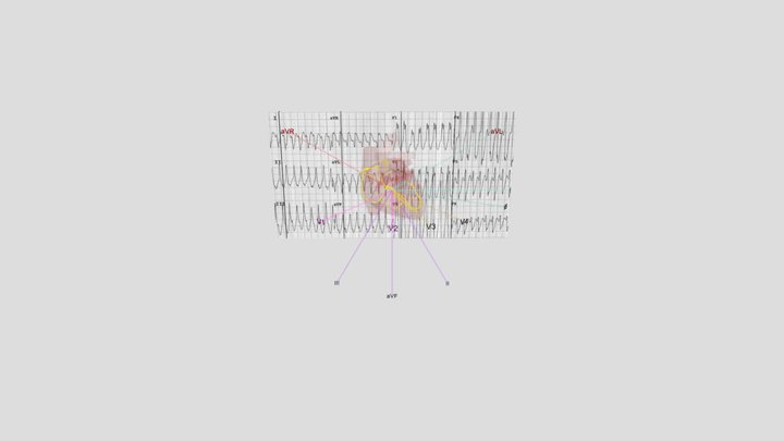 Antidromic AVRT synced with ECG 3D Model