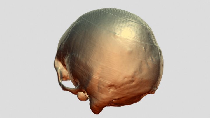 Skull Posterior Trauma 3D Model