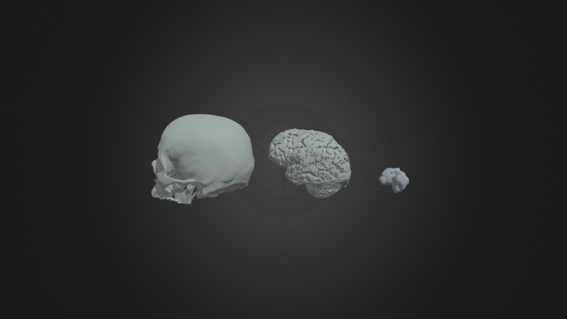 Brain, Tumor, and Skull — Sketchfab embed 3D viewer