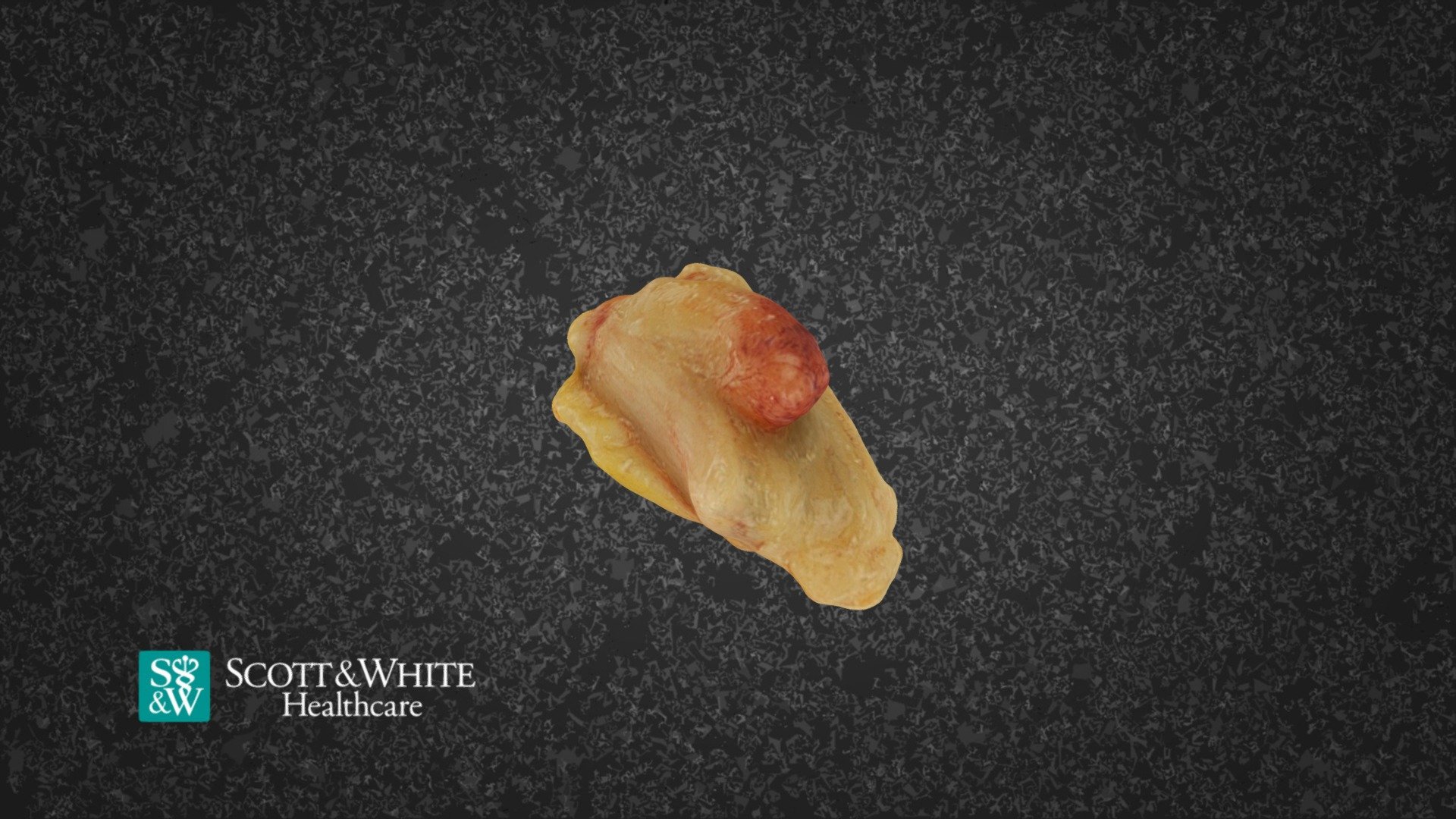 Vulva Bartholin Gland Cyst 83179 3d Model By Scott And White Moulage