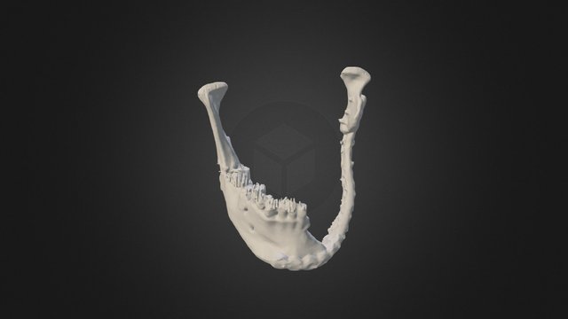 Reconstruction of Mandibular Defects 3D Model
