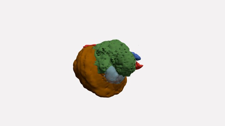 Tumornephrectomy 8/12/20 3D Model