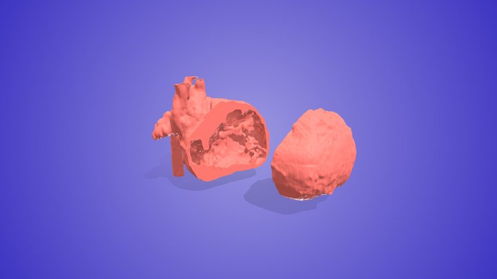 Tetralogy of Fallot with APVS 3D Model