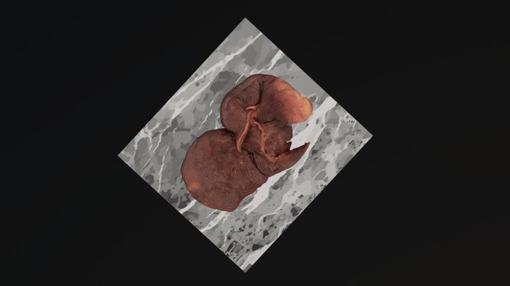Lung Tumor 2 3D Model