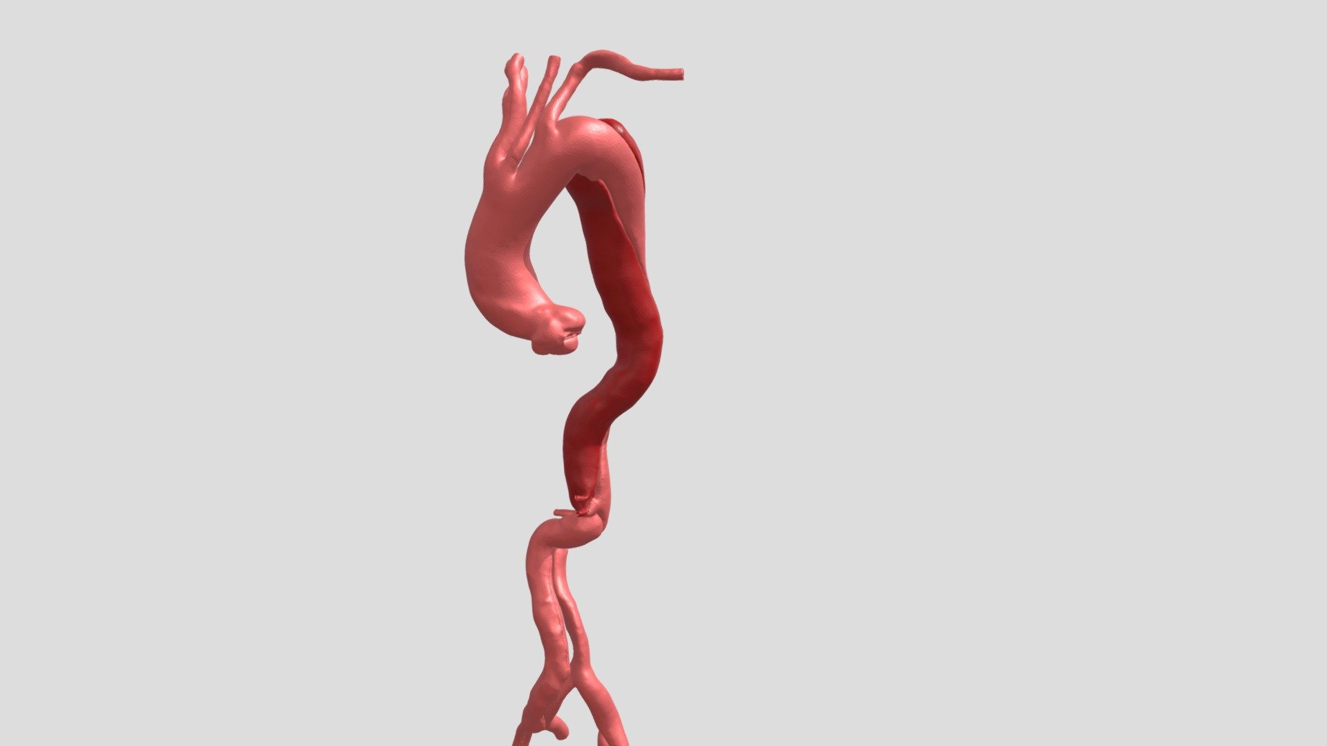 A10SL02122020 DISSEZIONE AORTA Test Colori