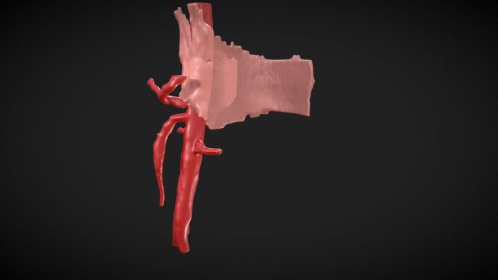 Median Arcuate Ligament Syndrome 3D Model