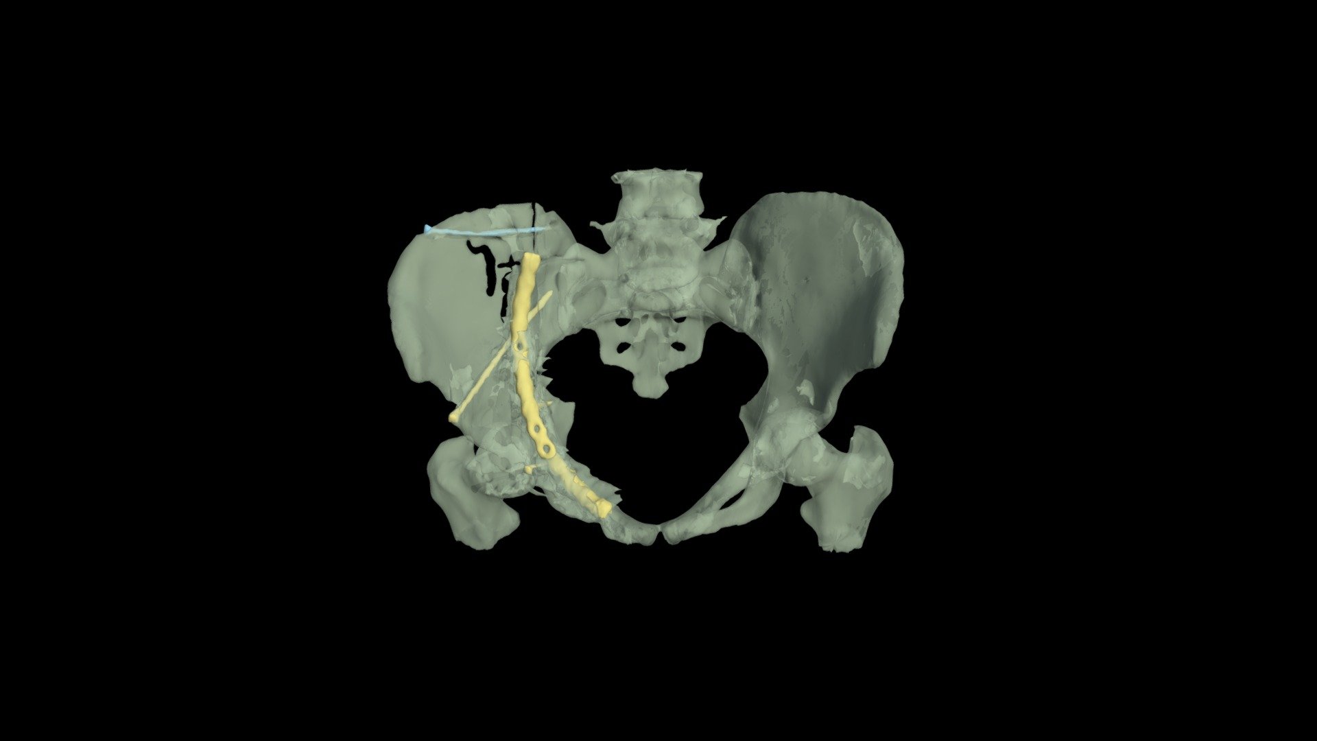 Pelvis Segmentation - Download Free 3D Model By Zstetter [7d3e363 ...