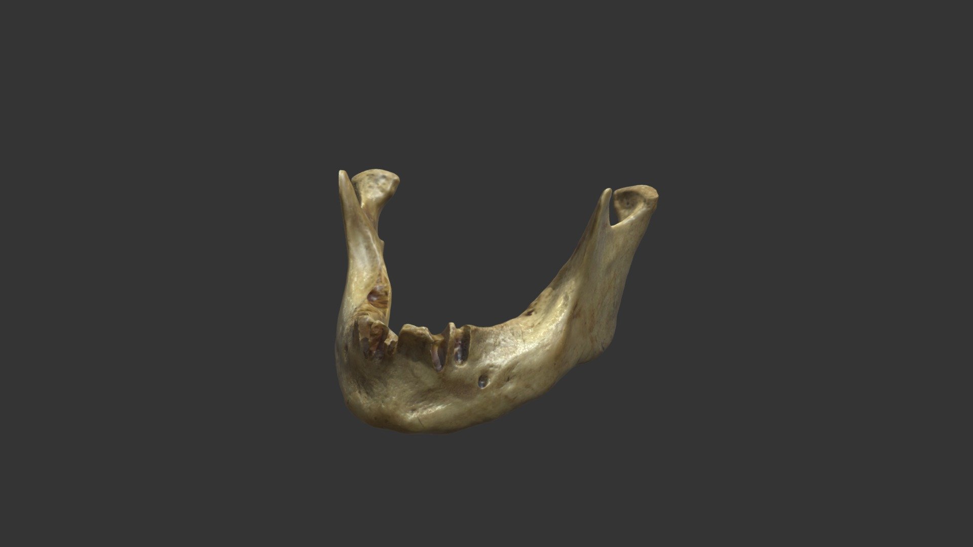 Mandible with mandibular canal variations - 3D model by iSCAN ...