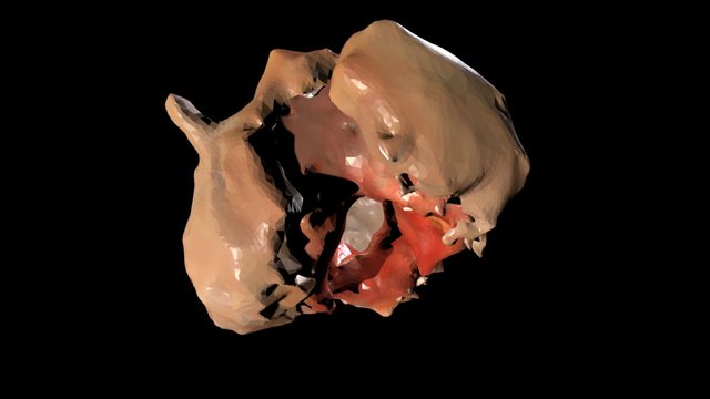 Normal Patient Aortic Leaflet and Root