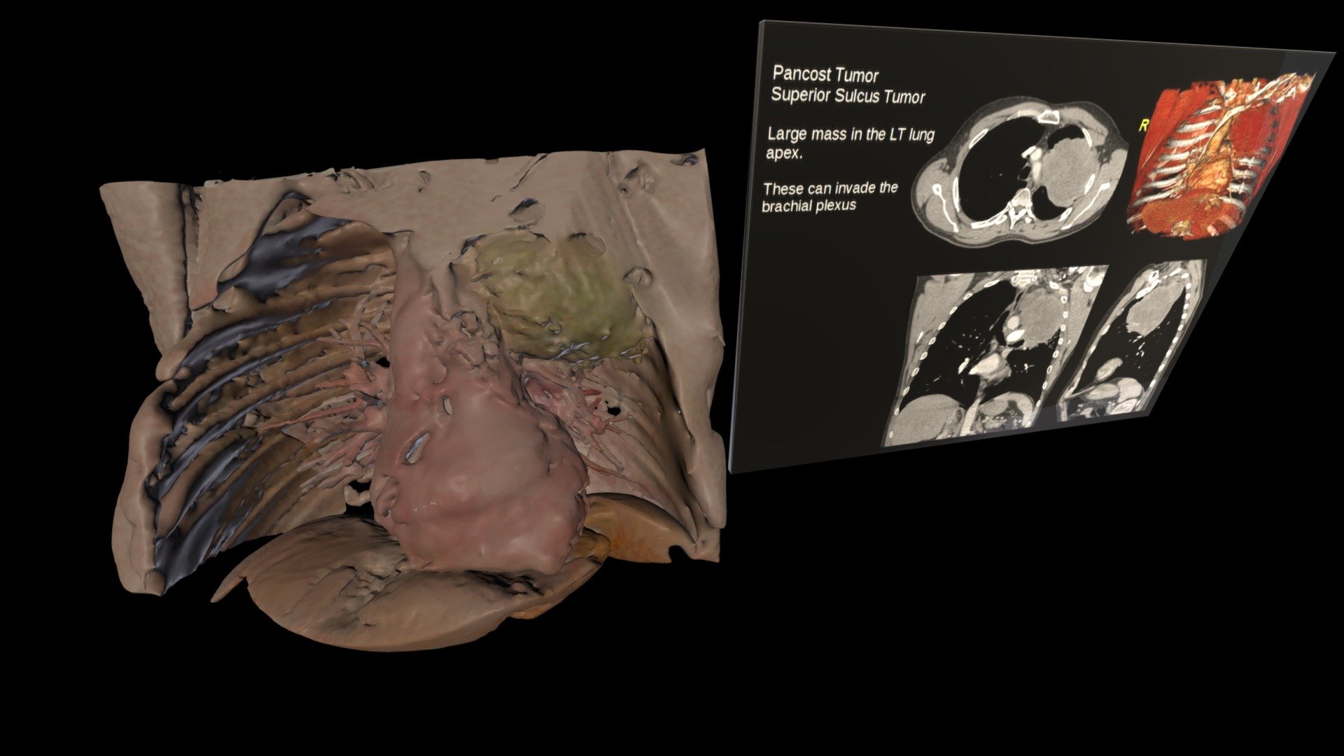 Lung Cancer Pancost Tumor