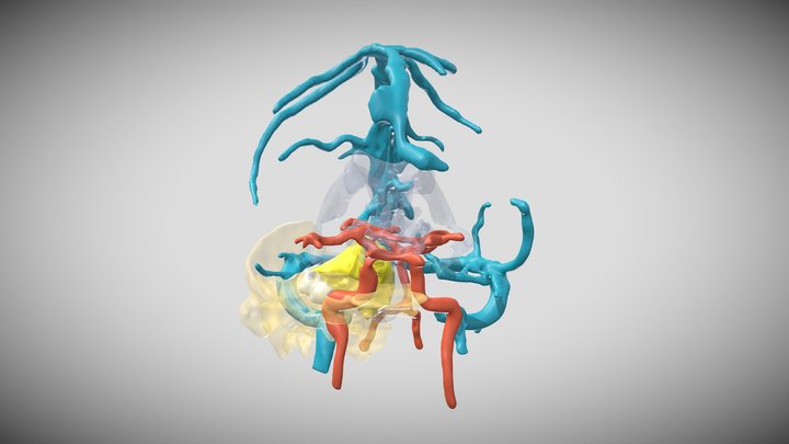 VIII cranial nerve Schwannoma 3D Model