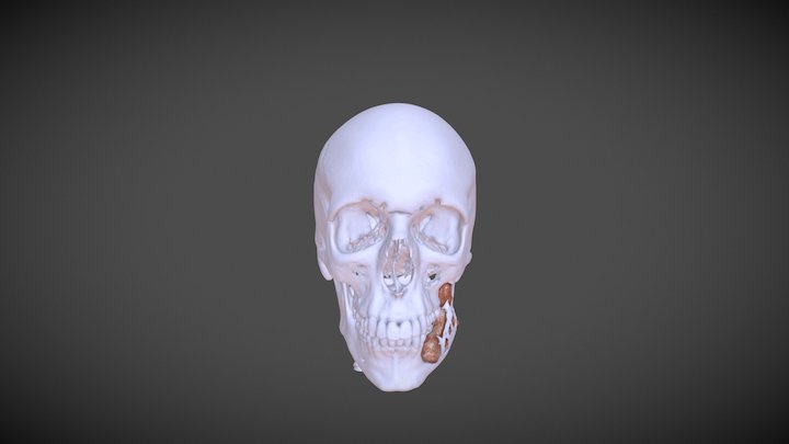 Maxillo Facciale con neoplasia 3D Model