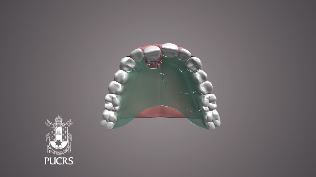 DENTES - Springs buccal movement - 3D model by fuscaldo [7f50cf1 ...