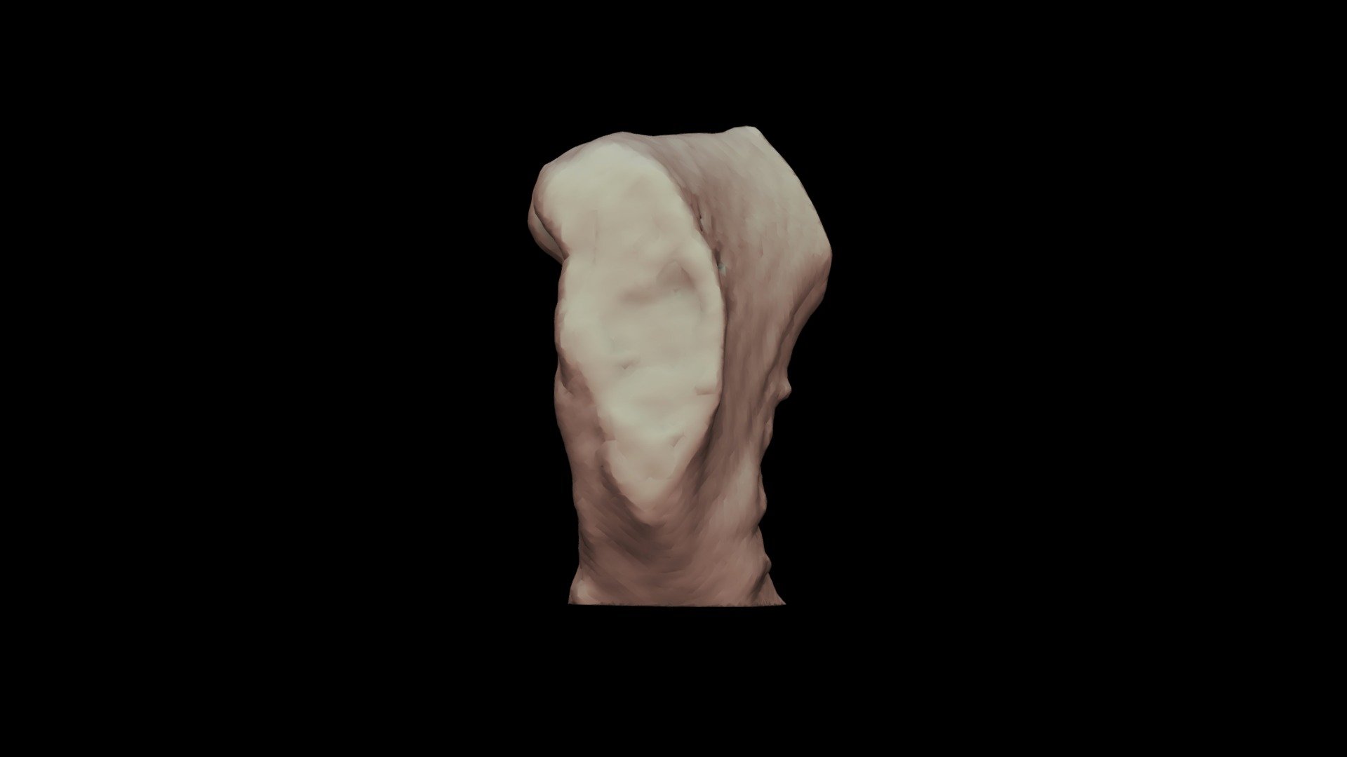 Pubic Symphysis Male 73yo
