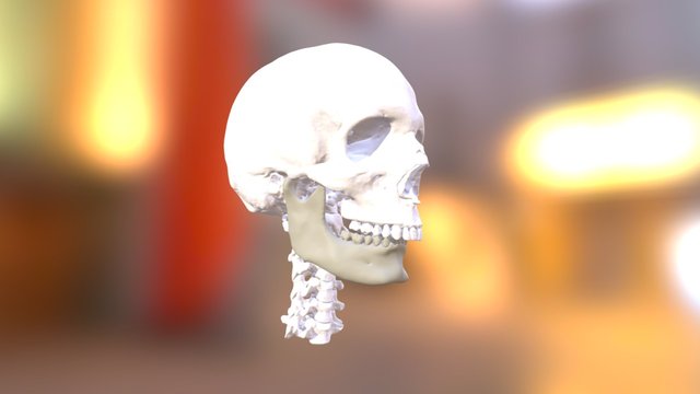 Jaw Surgery + Facial Implants (Original) 3D Model