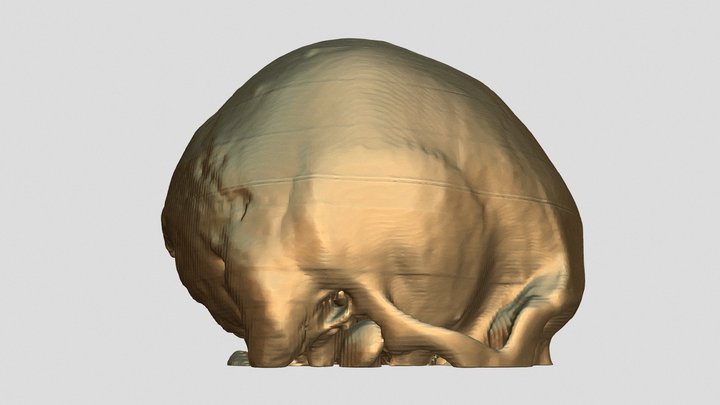 Skull Fracture 3D Model