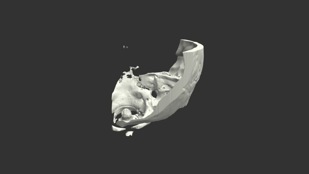 Superior Semicircular Canal Dehiscence - 3D model by Justin Cramer ...