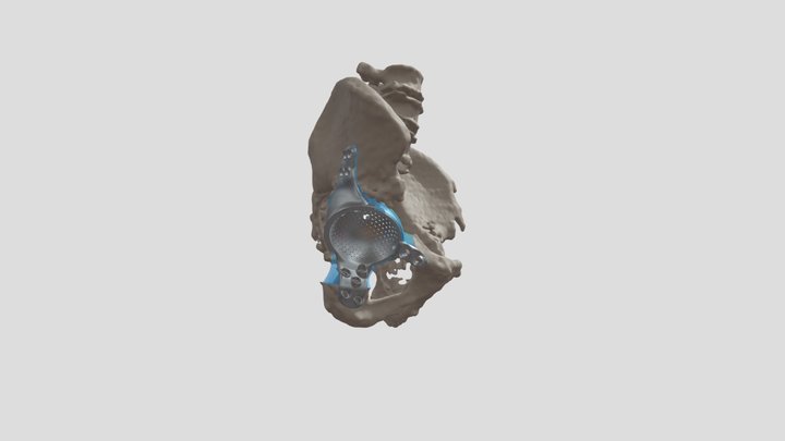 Hip Implant patient EM 3D Model