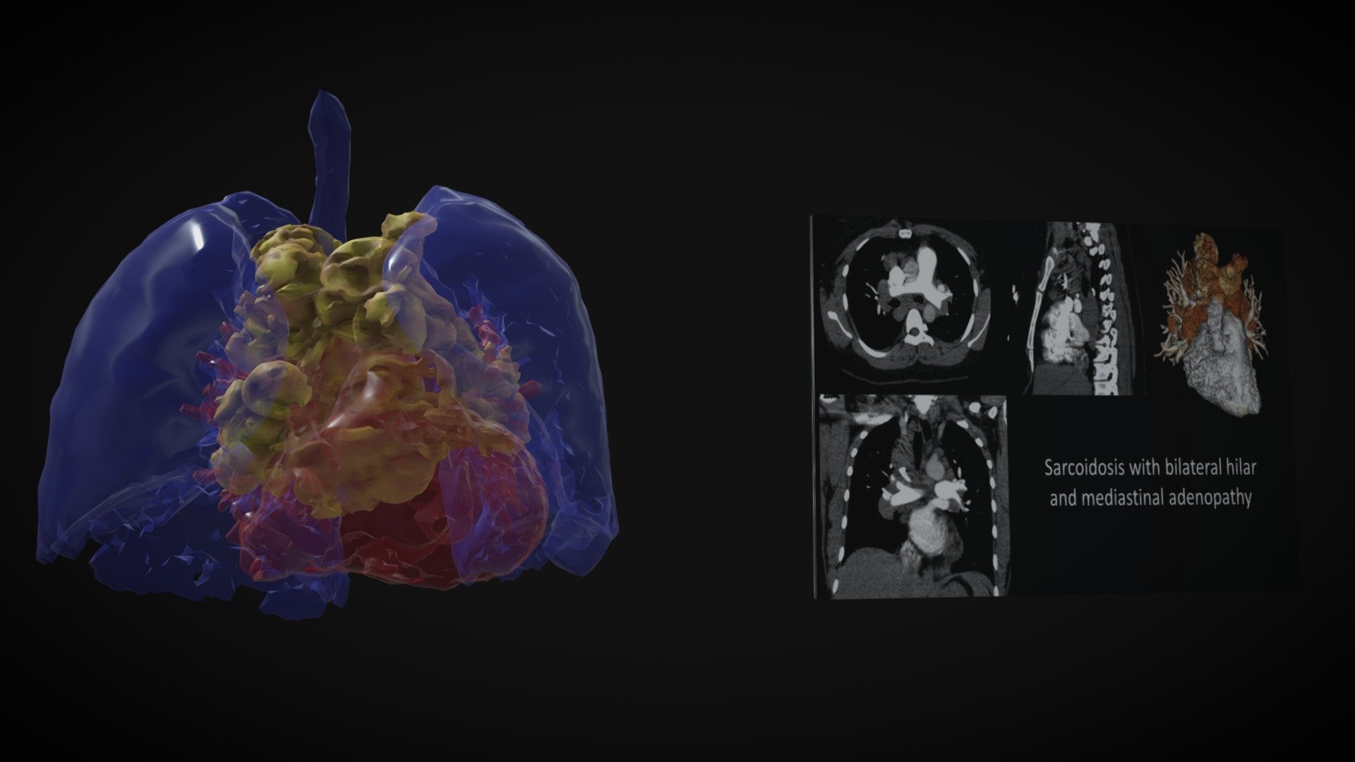 Sarcoidosis