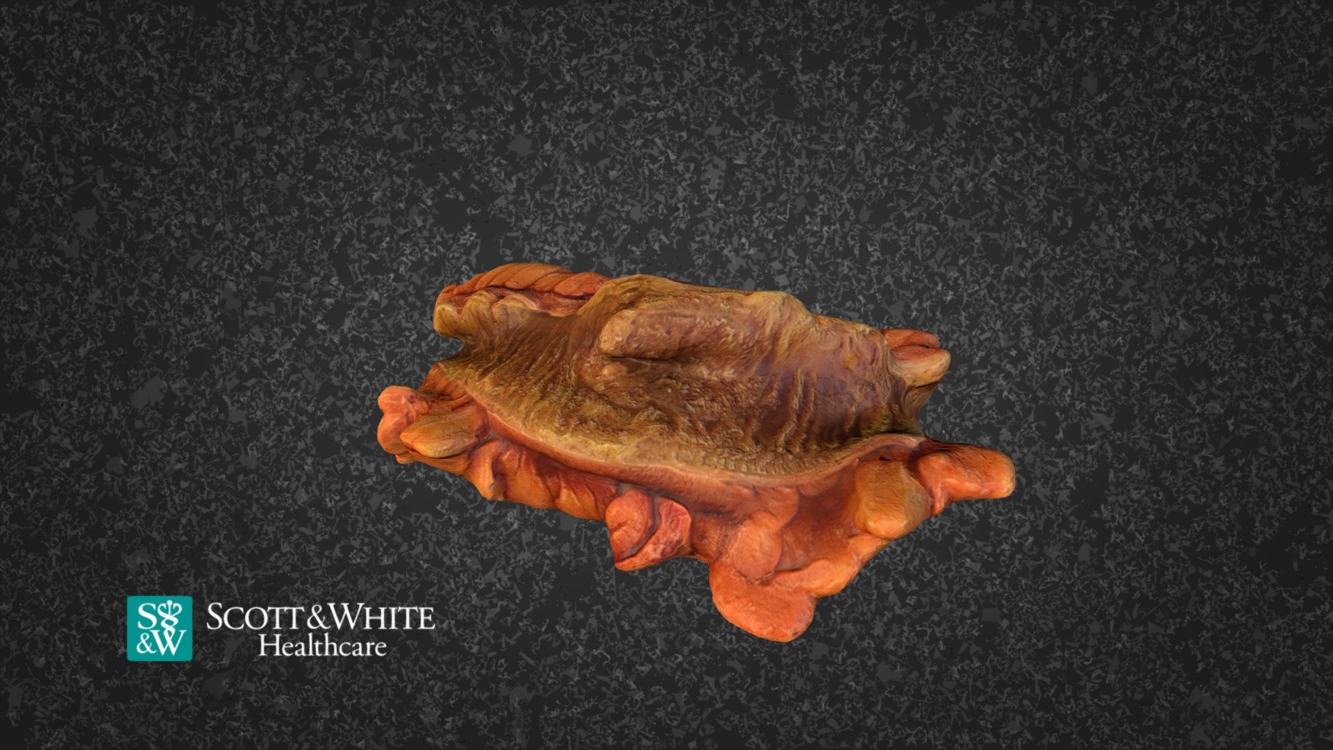 Rectosigmoid Adenoca Grade III 322674