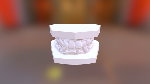 曾明志 矯正前 3D Model