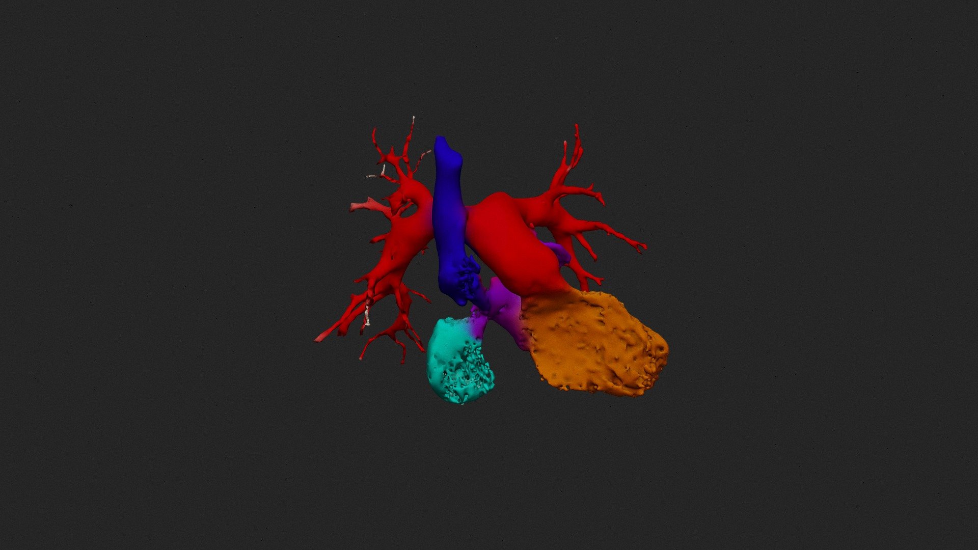 TGA, mustard procedure - Download Free 3D model by jonbra [81e1450 ...