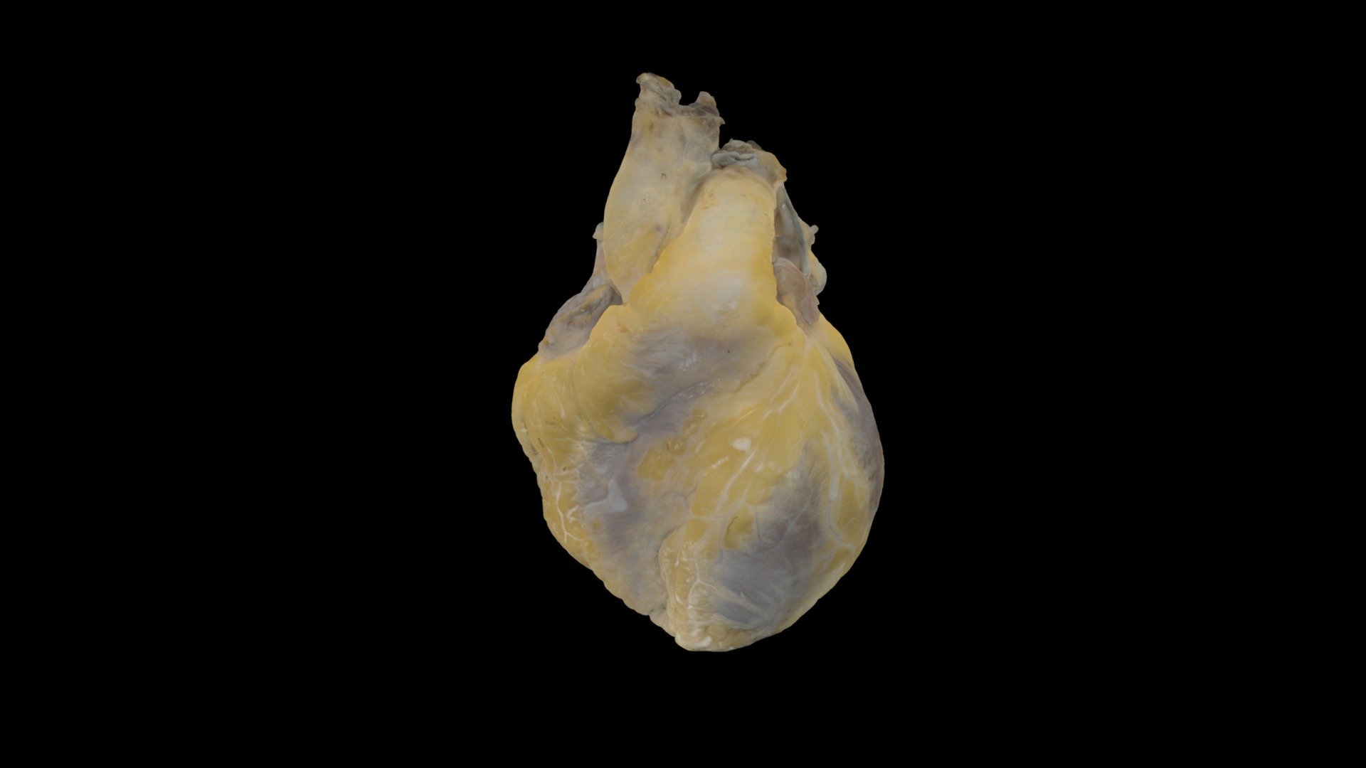 Perfusion Fixed Human Heart #0603