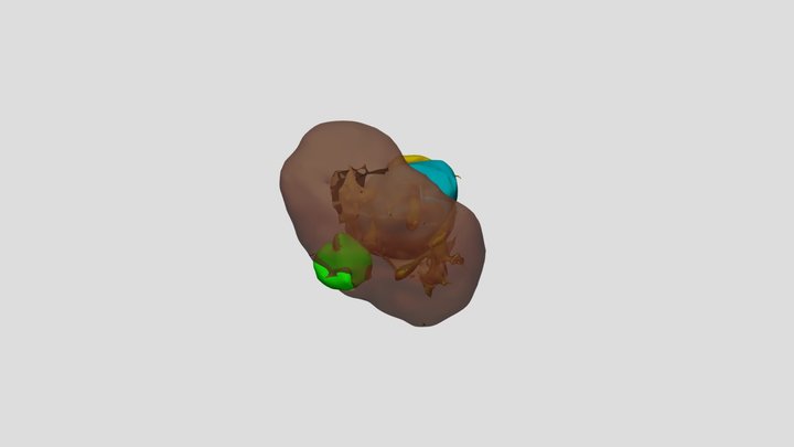 Nierenteilresektion rechts, 8.7.20 3D Model