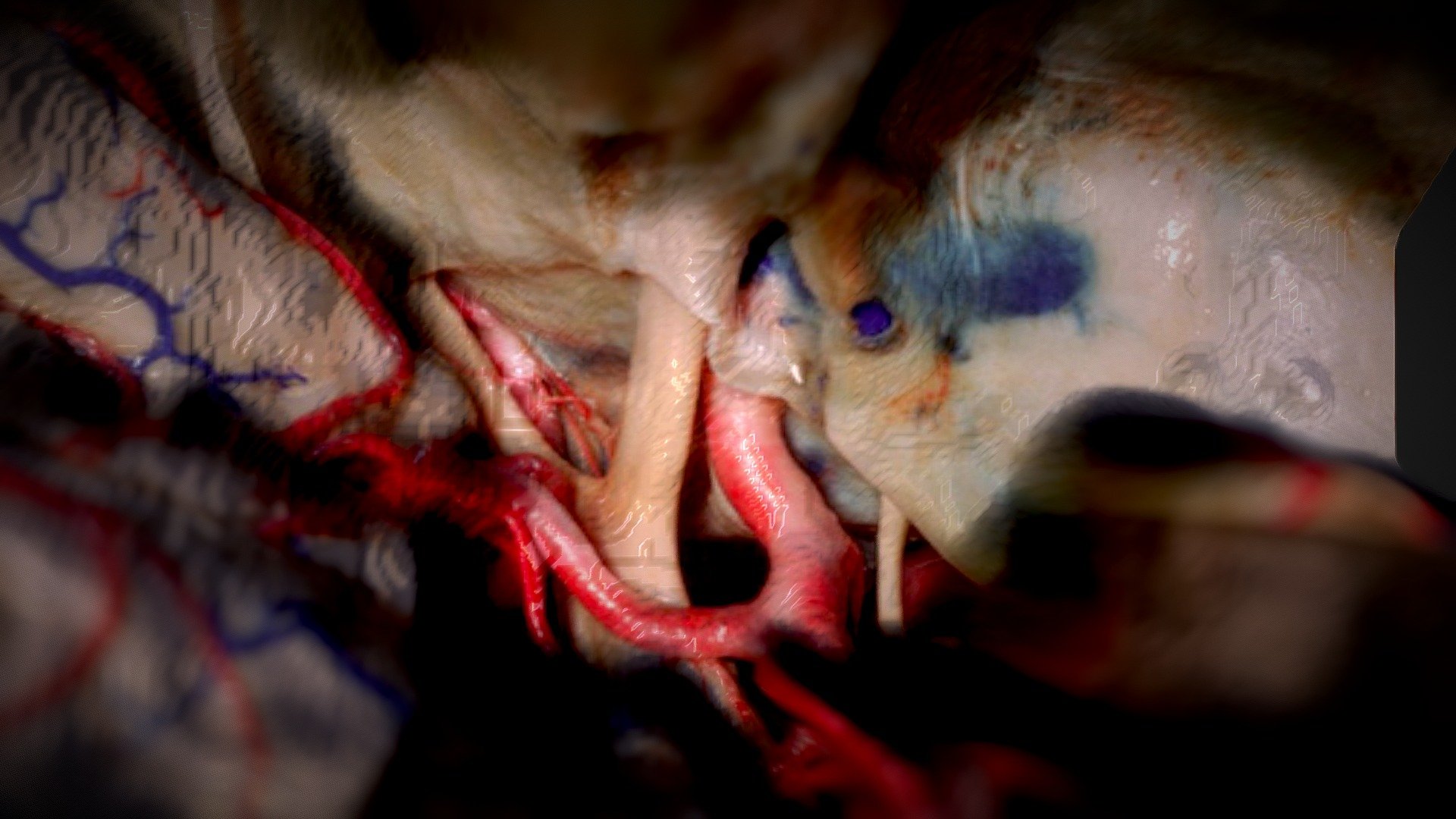 Orbitizygomatic pretemporal approach