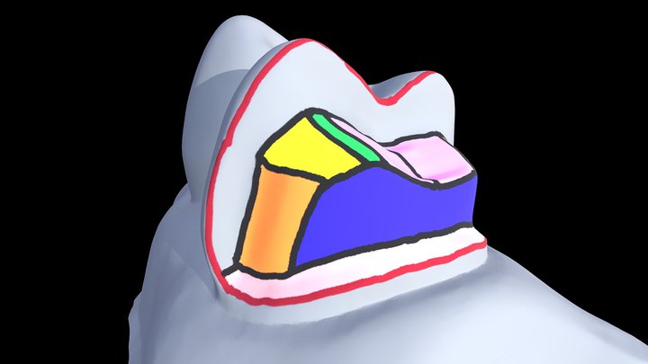 Areas of a Posterior Crown Preparation 3D Model