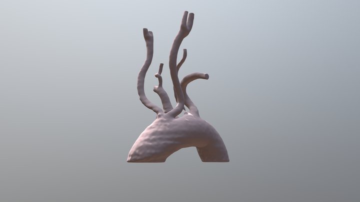 aortic arch with aberrant left subclavian artery 3D Model