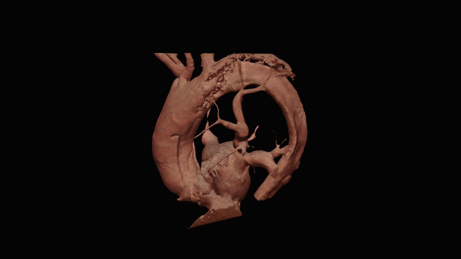 Type A Aortic Dissection - 3D model by tl0615 [83956db] - Sketchfab