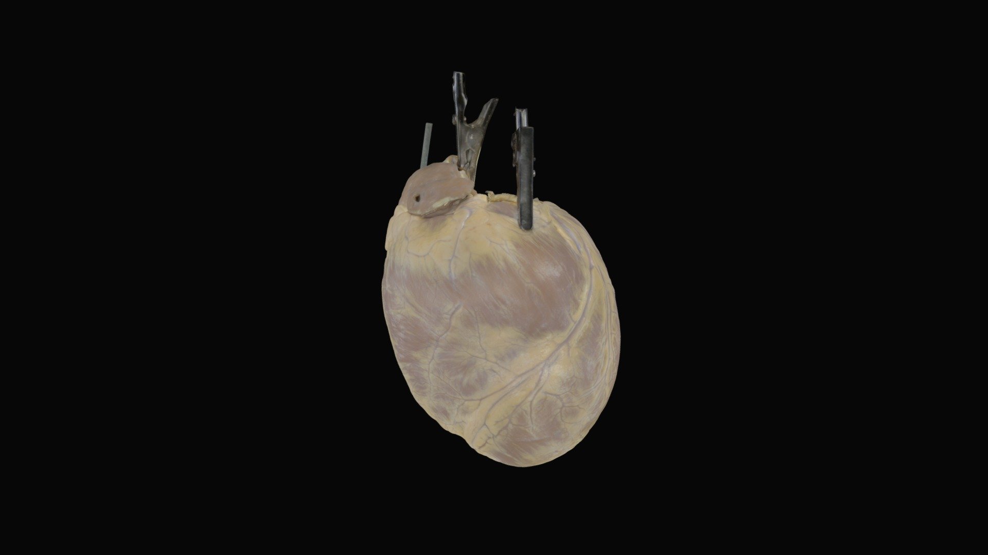 Fixed Human Heart with Severe Hypertrophy