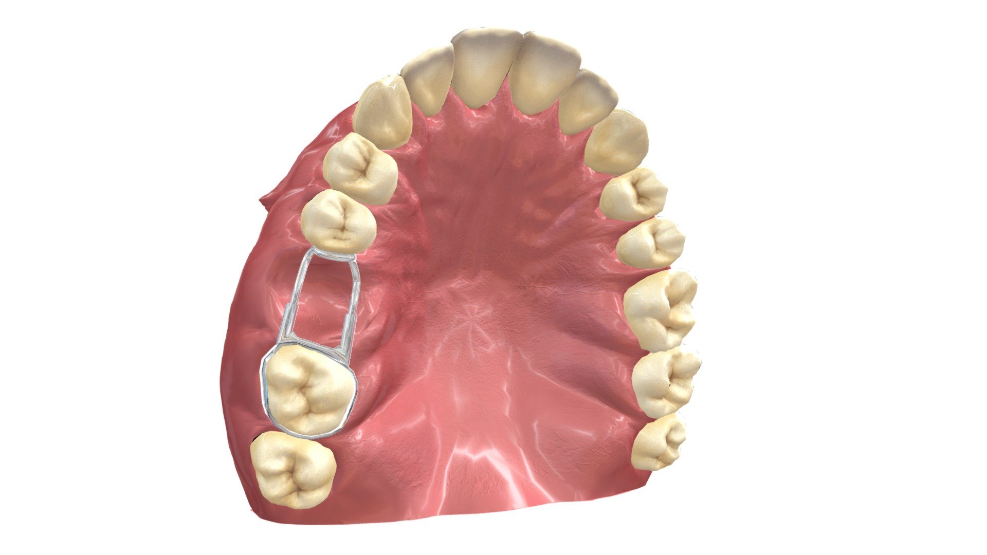 5. BAND AND LOOP SPACE MAINTAINER 3D model by Interactive 3D Data