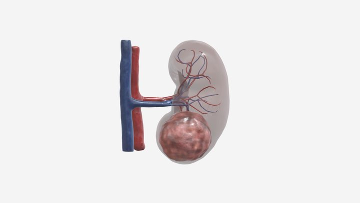 Kidney Cancer - Small Renal Mass Tumour 3D Model