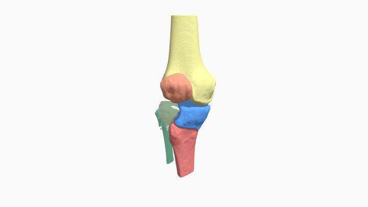 Tibial Plateau Fracture 3D Model